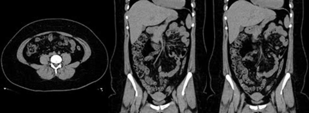 Fig. 4: 11 YEARS OLD.Appendicitis?
