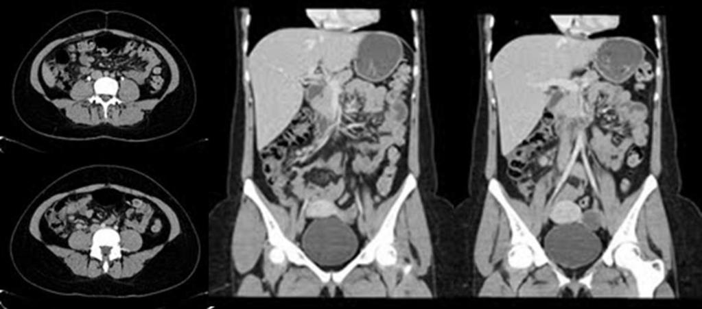 0 cm, pericecal. Fig. 5: 26 YEARS OLD. Suspected pyelonephritis.