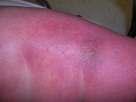Pseudomonas Cellulitis Localized or with septicemia Localized form is secondary infection Encouraged by maceration & occlusion Severe pain highly characteristic Pseudomonas Cellulitis The skin turns