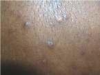 True statements about folliculitis include: A. It heals with some scarring B. It may be a complication of occlusive topical steroid therapy C. It is best treated with oral antibiotics D.