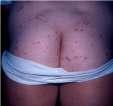 Pseudomonas Folliculitis A.k.a. Hot tub folliculitis Temp skin moisture = overgrowth Contaminated whirlpool, hot tub, waterslide, physiotherapy pool, or loofah sponges Courtesy of Dr.