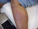 Cellulitis Infection of the dermis & SQ tissue Usually group A strep & S.