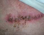 red, swollen, tender plaque with indefinite border Chills, fever, edema, bullae Courtesy of