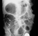 Clinical Manifestations Carrier state : reservoir Diarrhea with colitis Manifestations of C.