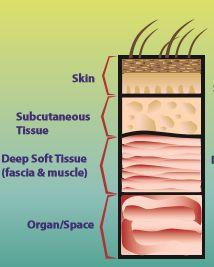 Definition of SSIs according to their superficial or deep site Superficial incisional SSI 1. Purulent drainage from incision 2. Cultures+ from aseptically obtained fluid or tissues in incision 3.