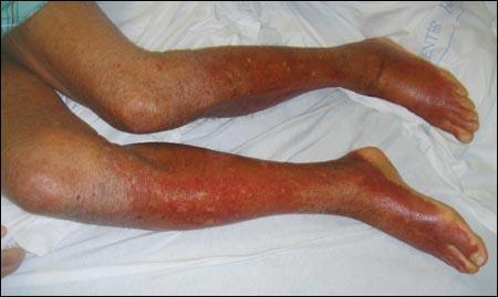 Differentiate Between Cellulitis and Non