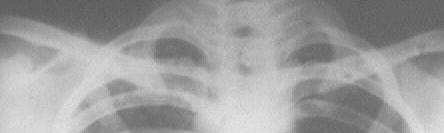 Tropical pulmon nary eosinophilia