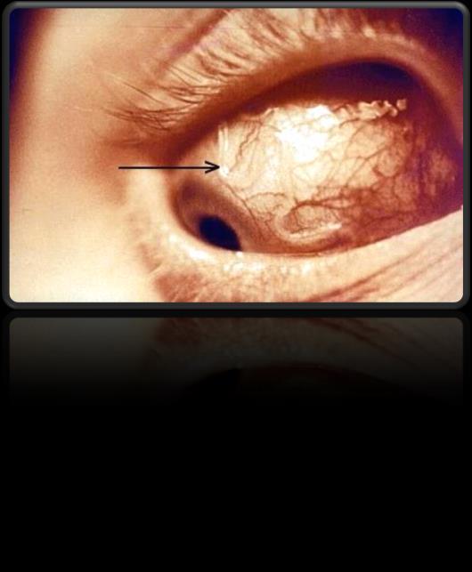 Loiasis of the eye 2. Calabar swellings : allergic reaction to worm metabolites.