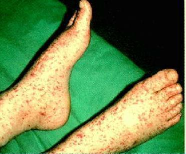symptoms of RMSF fever myalgia, headache, petechial rash (usually on palms of hands and soles of feet),