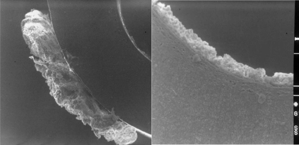 Biofilm on an indwelling catheter