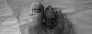 Microbiology of Diabetic Foot Infections (DFIs) Dependent on
