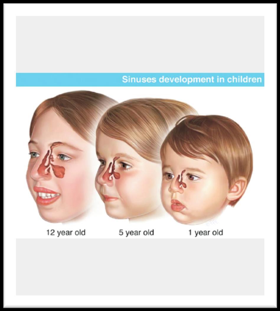 Acute bacterial sinusitis Dx: Inflammation of the mucosal lining Usually viral URI (