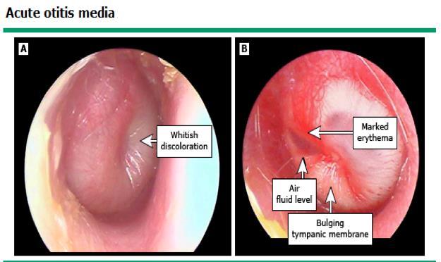 Acute otitis media Dx of OM fluid in the middle ear plus acute signs of