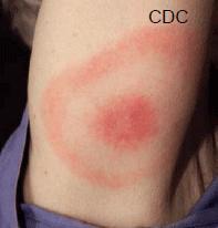 Symptoms of Lyme disease Erythema migrans (bull s eye rash) Early symptoms of Lyme disease usually occurs within one to two weeks, but can occur as soon as three days or as long as a month, after a