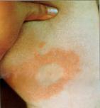 Early Symptoms of Lyme Disease Non-specific flu-like symptoms Erythema
