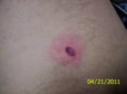 2006;354:2794-801) Reported in about 60% of CA cases EM Rash.
