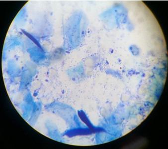 Otitis Externa Associated with Scabies and Its.