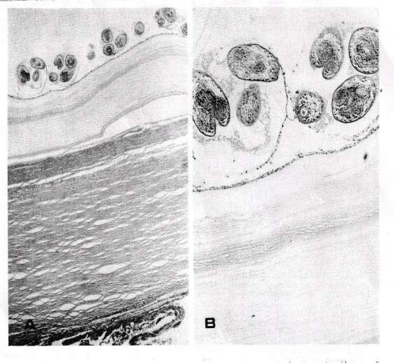 D- Endogenous Daughter Cyst: sometime the cyst rupture and the parasite try to survive itself by formation of endogenous daughter cyst within the mother cyst.