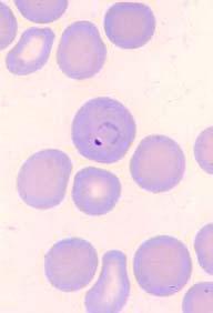 Types of Malaria in Humans Plasmodium vivax Benign tertian malaria 1. Name comes from: a.