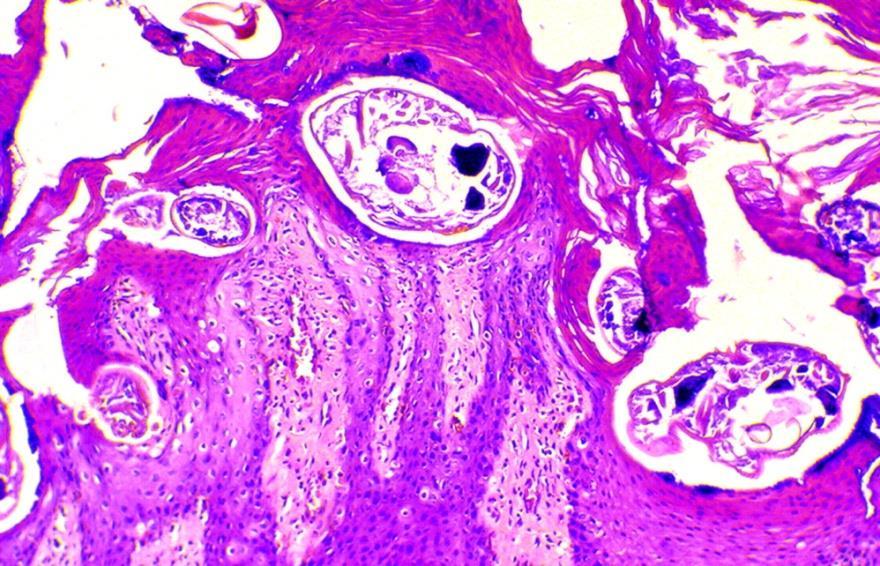 Sarcoptes scabiei Pathogenesis: Tunnelling & feeding activities of the mites cause irritation inflammation, exudation, crusting, alopecia & hyperkeratosis Intense pruritus self-trauma (excoriations)