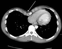 Chest CT-scan
