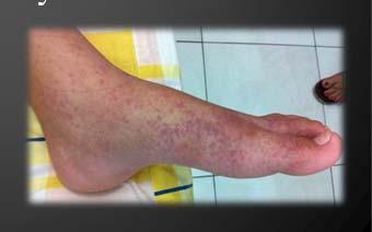Chikungunya Signs & Clinical Symptoms Incubation period 2-6 d, symptoms appearing 4 7 d post-infection Symptoms include: Rash Pain in the Lower Back Joint Pain (with or without swelling) Headaches