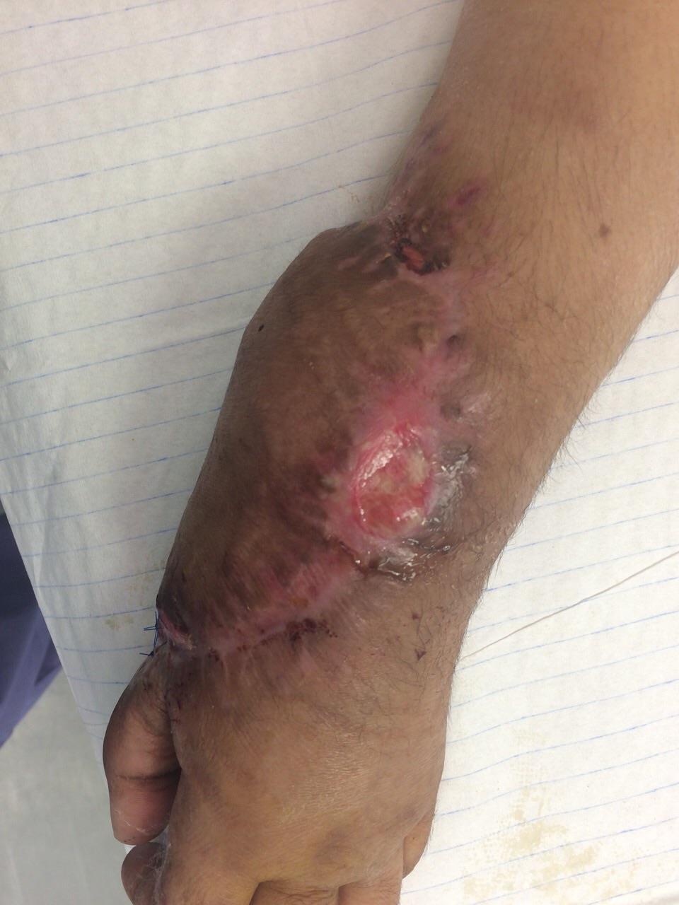 Case I 35-year-old female. RTA with comminuted fracture of left forearm.