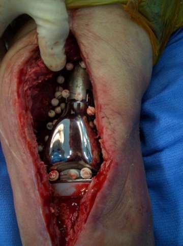 Removal of an infected prosthetic joint