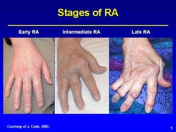 Post-streptococcal diseases rheumatic fever glomerulonephritis rheumatoid