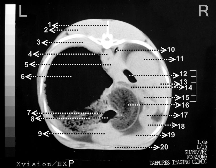 part of 11th and the cranial part of 12th thoracic vertebrae (Figure 4 to 5) and continued at the right side of abdominal cavity to the level of 5th lumbar vertebra (Figure 11).