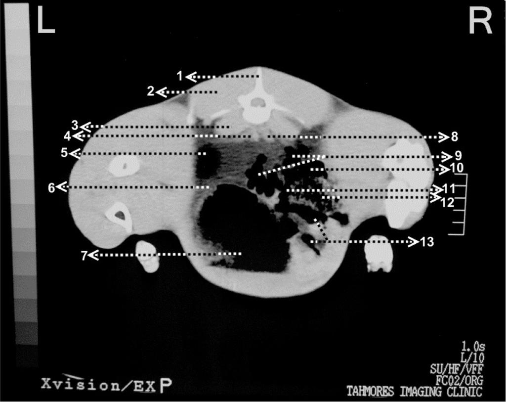 Seyed Mohsen Sajjadian et al. Computed Tomographic Anatomy of the Abdominal Cavity in the Jebeer Figure 11. 1. 5th lumbar vertebra, 2. epaxial muscles, 3. sublumbar muscles, 4. aorta, 5.