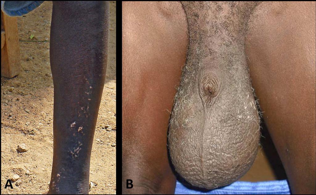 Fig 1. Clinical signs of onchocerciasis (A) and lymphatic filariasis (B) in the same individual living in an area coendemic for both infections in Lofa County, Liberia.