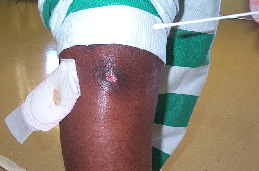 aureus: prevalence in skin and soft tissue infections at