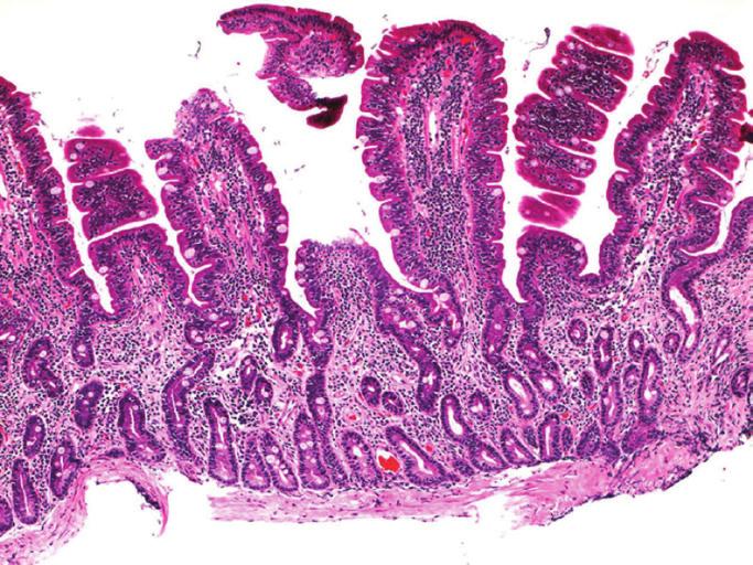 fusion) eosinophils neutrophils (suppurative) macrophages (histiocytic) epithelial injury (flattening, erosion, ulceration) crypt dilatation/ distortion/ (colon) hyperplasia mucosal atrophy/ fibrosis