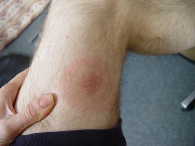 Initial Symptoms of Lyme Disease Appear from three days or as long as a month