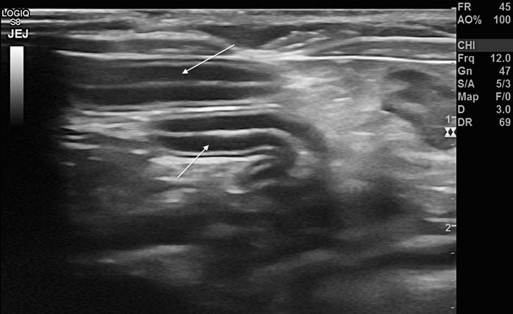 How would you interpret this ultrasound image? Answer The ultrasound image shows a section of intestine.