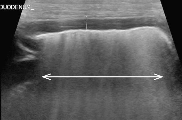 Figure 4b. Normal shadowing from normal intraluminal intestinal gas (arrow) in the duodenum.