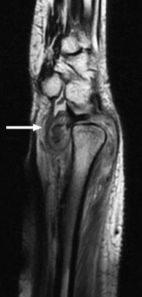 (b) MR image of the patient s wrist shows septic arthritis of the distal radioulnar joint and osteomyelitis of the ulnar head (arrow).