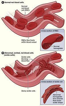 oxygen ecause they lock circulation Sickle-Cell Disease Heterozygotes have a