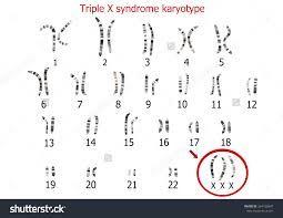Triple X Syndrome: These people have three X chromosomes