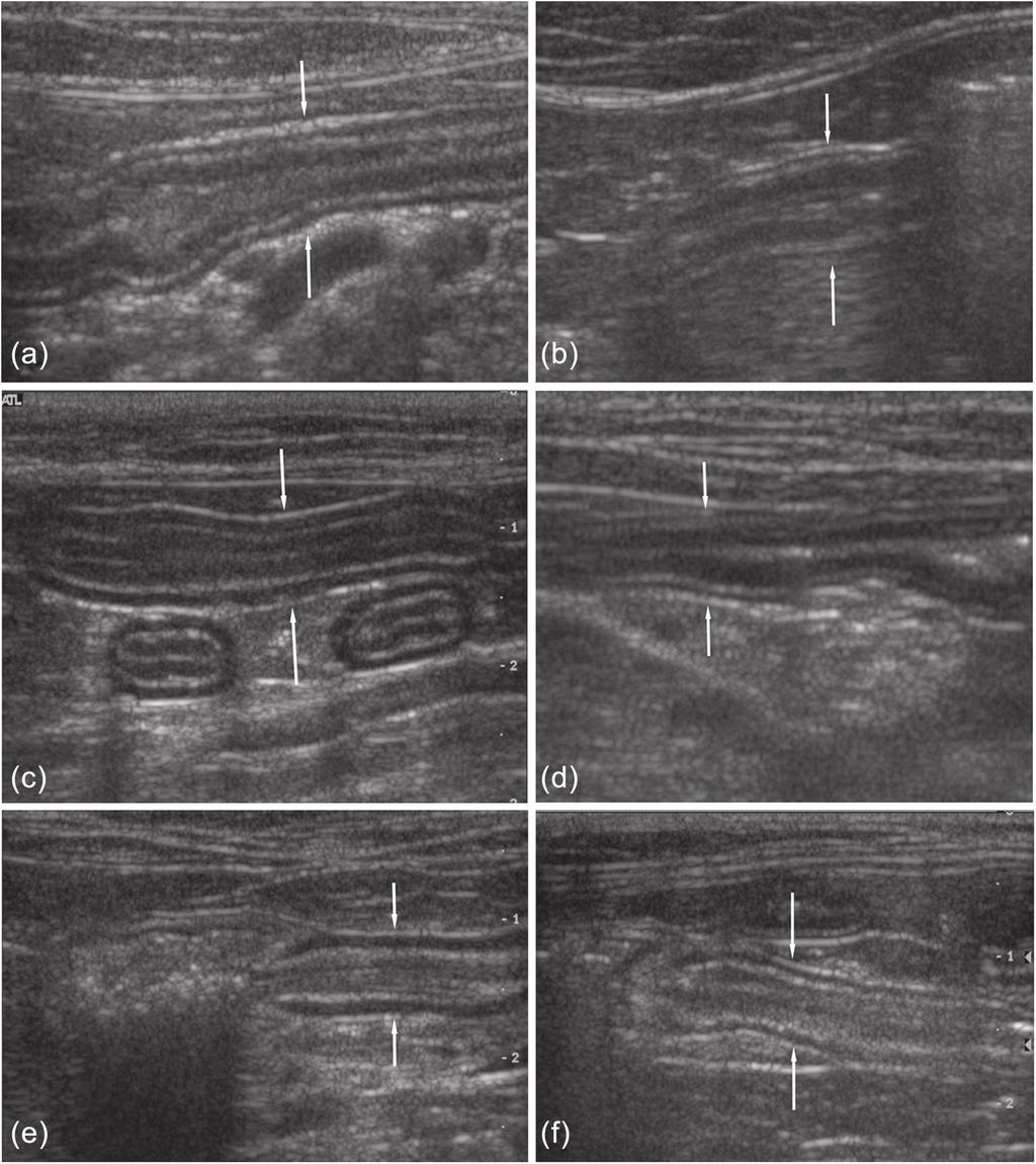 Daniaux et al 95 Figure 3 Ultrasonographic longitudinal images of the duodenum (a, b), jejunum (c, d) and ileum (e, f). The images on the left are of cats with lymphoma (a, c, e).