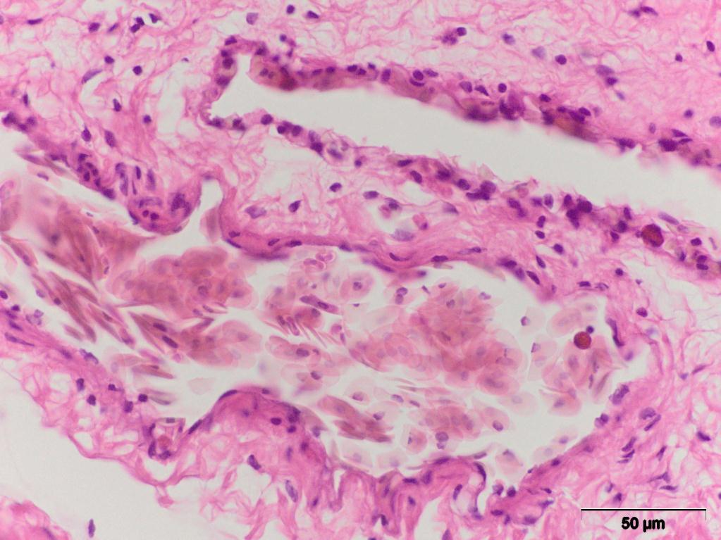 Izražena peribronhijalna infiltracija, mnoštvo eozinofilnih granulocita intraalveolarno i intraseptalno i nalaz Haemogregarina stepanowi u krvnom sudu uočen je kod 2/30 (6,6%) kornjače (slika 33).