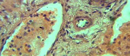 different stages of immature flukes with mechanical destruction of liver tissue (H&EX100).