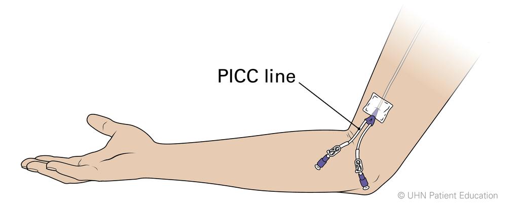 Peripherally Inserted Central Catheter (PICC) The PICC is another type of CVC. Here are some facts about the PICC: It is put in an arm vein and leads up into a large vein in the chest.