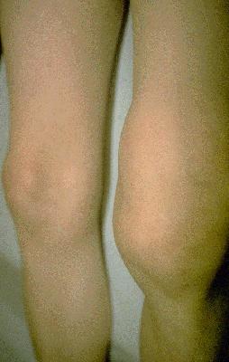 Lyme Arthritis Symptoms Joint swelling Joint pain