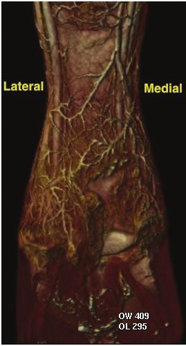 CONCLUSION Probable necrosis or abscess in the medial heel, extending into the sensitive lamina of the medial aspect of the hoof.