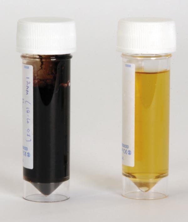 Figure 2: Urine from a dog with Babesia canis infection revealing gross discolouration due to haemoglobinuria at presentation, compared to normal urine passed immediately prior to discharge four days