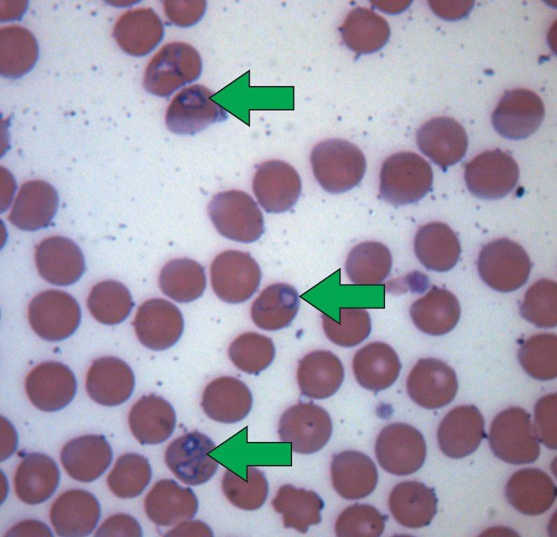 excessive red cell breakdown (Figure 2).