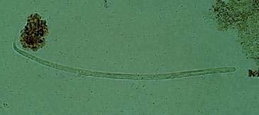 Loa loa microfilaria Dracunculus