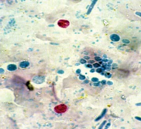 Cryptosporidium Are found in Jordan Cryptosporidium species, typically C. parvum, can infect the intestine in immunocompromised persons. C. parvum is a protozoal infection which causes an acute diarrhea in immunocompromised patients.